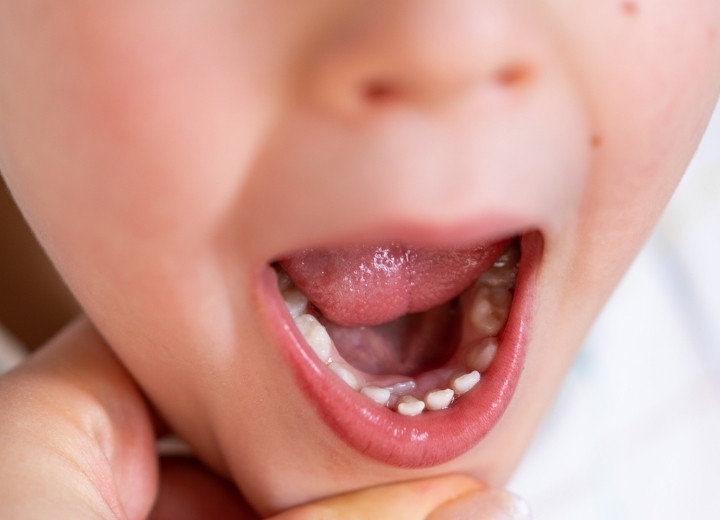 Caída de dientes de leche. Odontopediatra Gijón