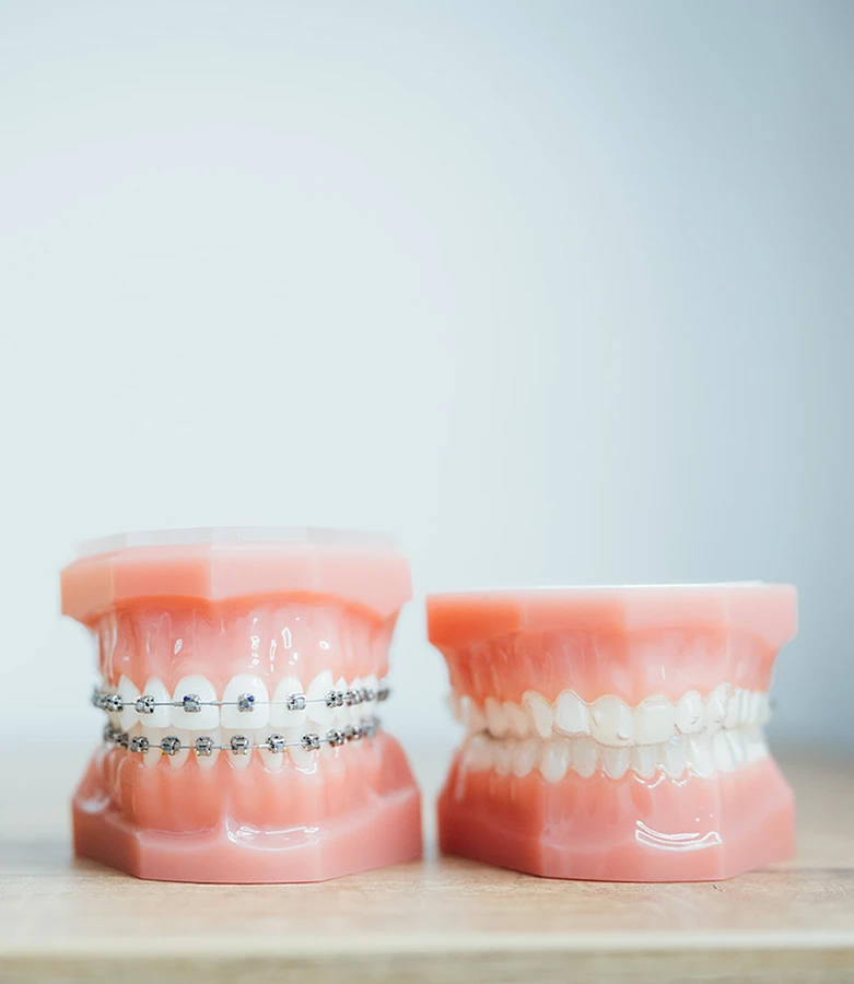 Ortodoncia con brackets en Gijón