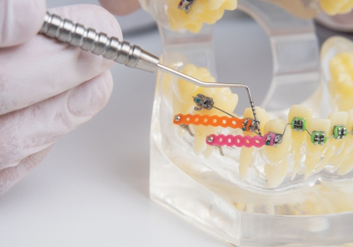 Microtornillos de ortodoncia
