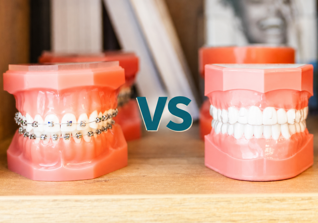 Ortodoncia invisible o brackets: alineadores transparentes y brackets en Clínica Dental Peña, Gijón
