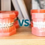 Ortodoncia invisible o brackets: alineadores transparentes y brackets en Clínica Dental Peña, Gijón