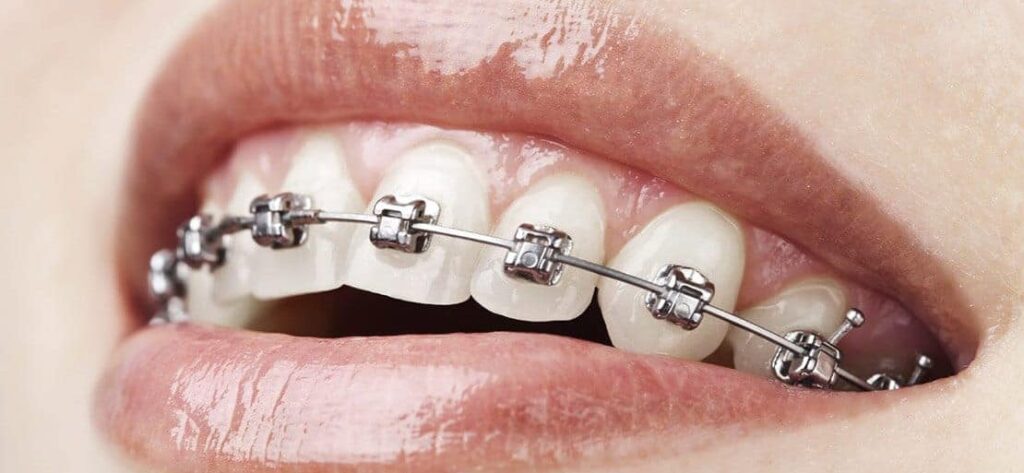 Brackets de autoligado en Clínica Dental Peña, Gijón