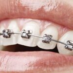 Brackets de autoligado en Clínica Dental Peña, Gijón
