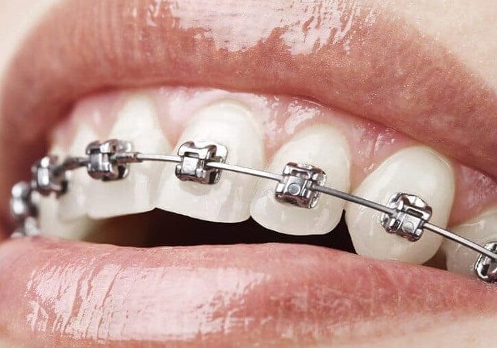 Brackets de autoligado en Clínica Dental Peña, Gijón